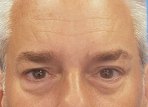 Male Botox After