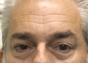 Male Botox Before