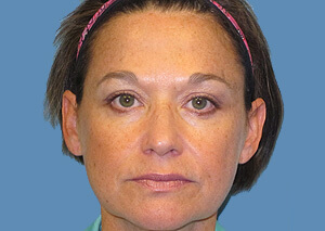 xeomin before after 2