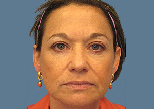 xeomin before after 1