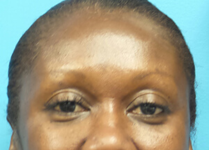 treatment botox