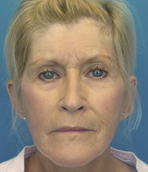 Liquid facelift before