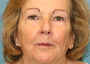 botox liquid facelift