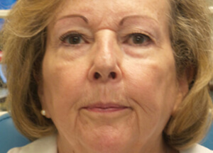 botox facelift