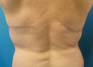 slimlipo after