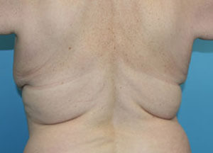 Bra Roll Liposuction before