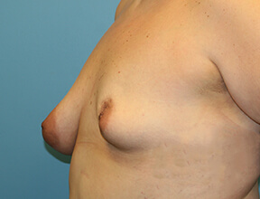 Breast Lift Before