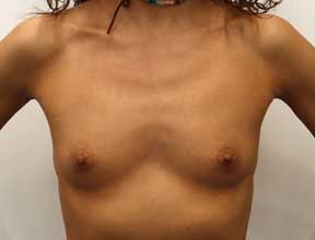 Breast Implant Before