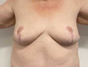 Breast Reduction - After