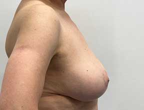 Breast Reduction - After