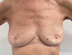 Breast Reduction - After