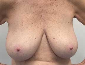 Breast Reduction - Before
