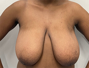 Breast Reduction - Before