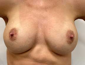 breast implant exchange after