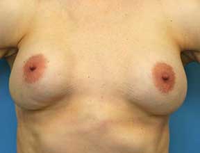 breast implant exchange after
