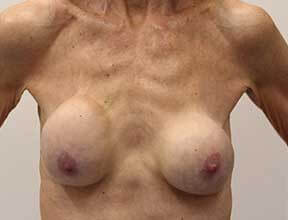 breast implant exchange after