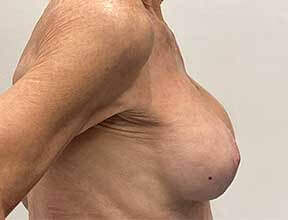 breast implant exchange after