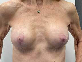 breast implant exchange after