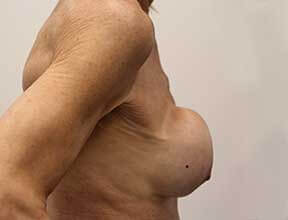 breast implant exchange after