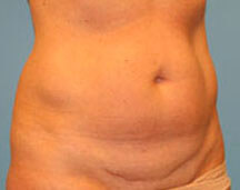 Coolsculpting After