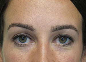 treatment botox