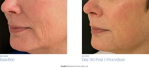 Ellacor Before + After