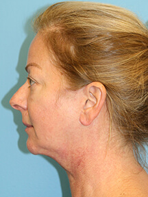 Fecelift after