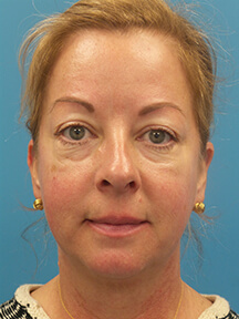 Facelift before