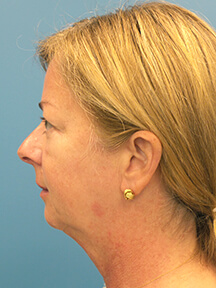 Facelift before