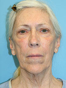 Facelift before