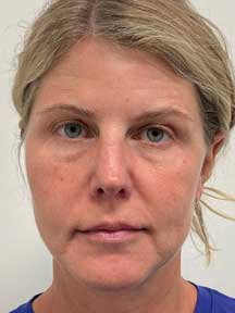 Facelift after