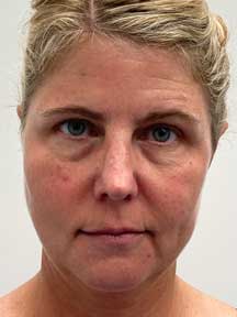 Facelift before