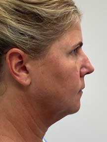 Facelift before
