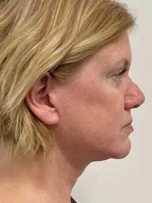 Fecelift after
