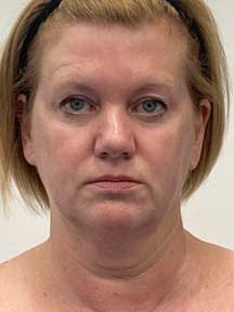 Facelift before