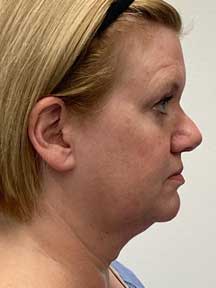 Facelift before
