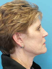 Facelift after
