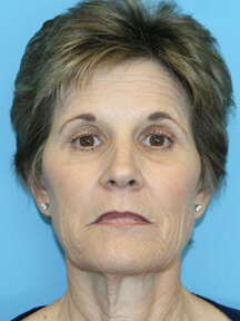 Facelift before