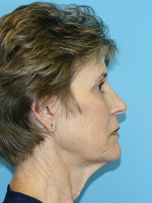 Facelift before