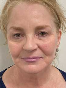 Fecelift after