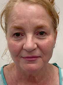 Facelift before