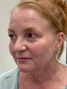 Facelift before