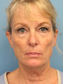Facelift before