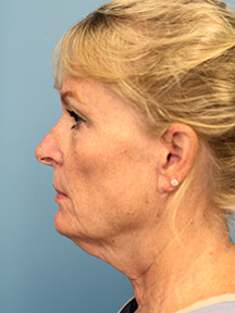 Facelift before