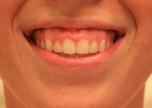 gummy smile