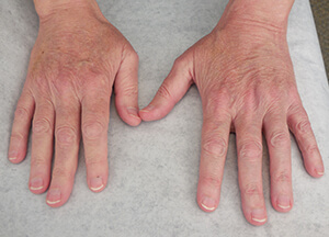 radiesse hands after