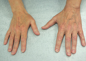 radiesse hands before