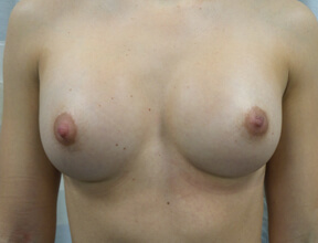 Breast Implant Exchange After