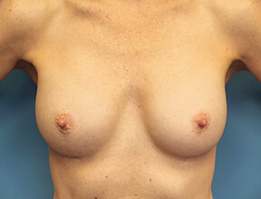 breast implant exchange after