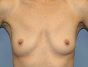 breast implant exchange after